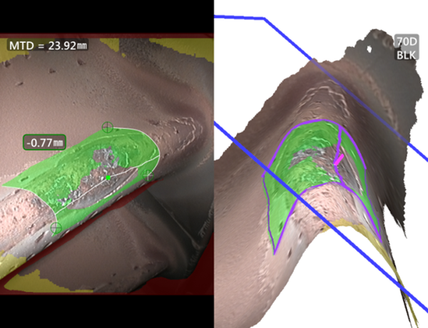 使用三維測量工業(yè)內(nèi)窺鏡測量凹坑深度 使用三維測量工業(yè)內(nèi)窺鏡測量凹坑深度